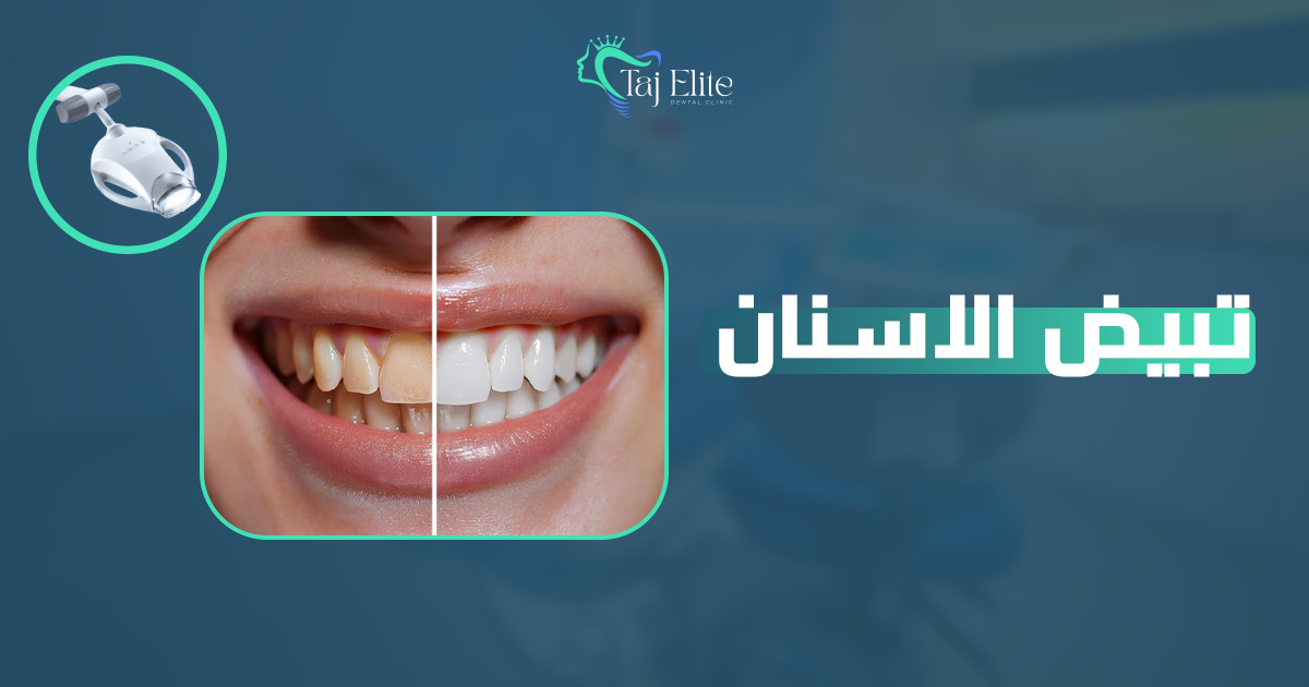 تبيض الاسنان