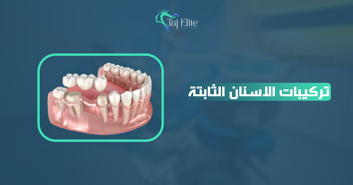 تركيبات الأسنان الثابتة (1)