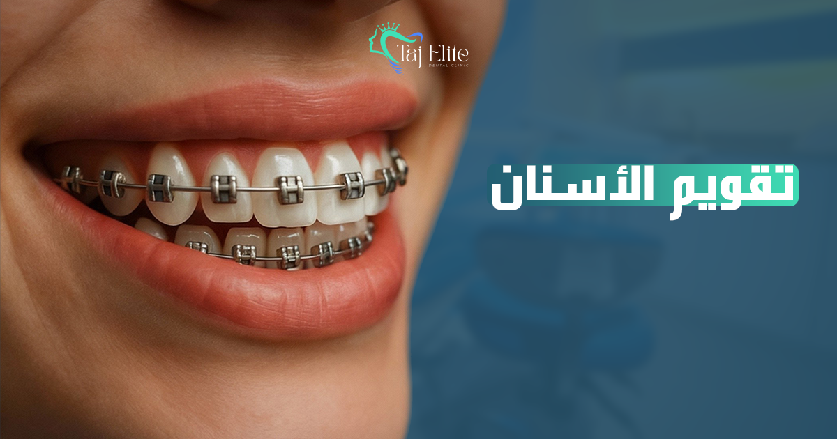 تقويم الأسنان