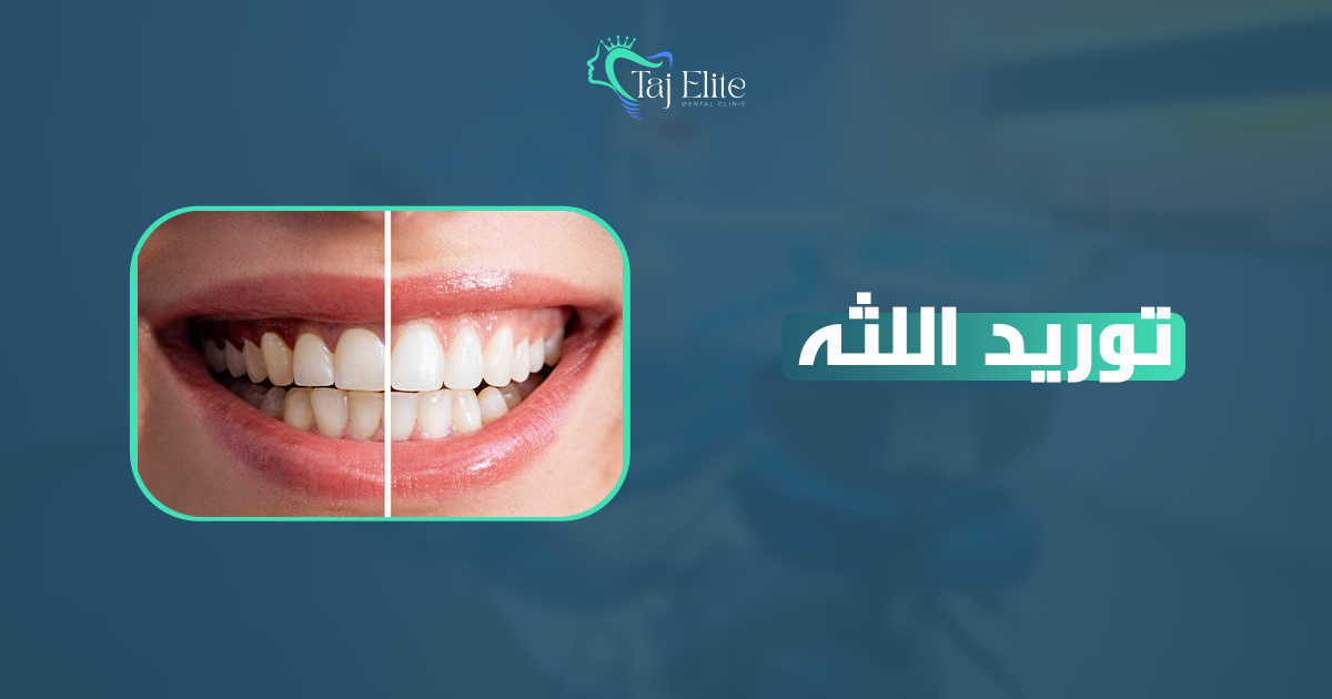 توريد اللثه (2)