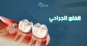 خلع الأسنان الجراحي