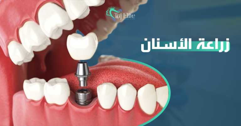 زراعة الأسنان