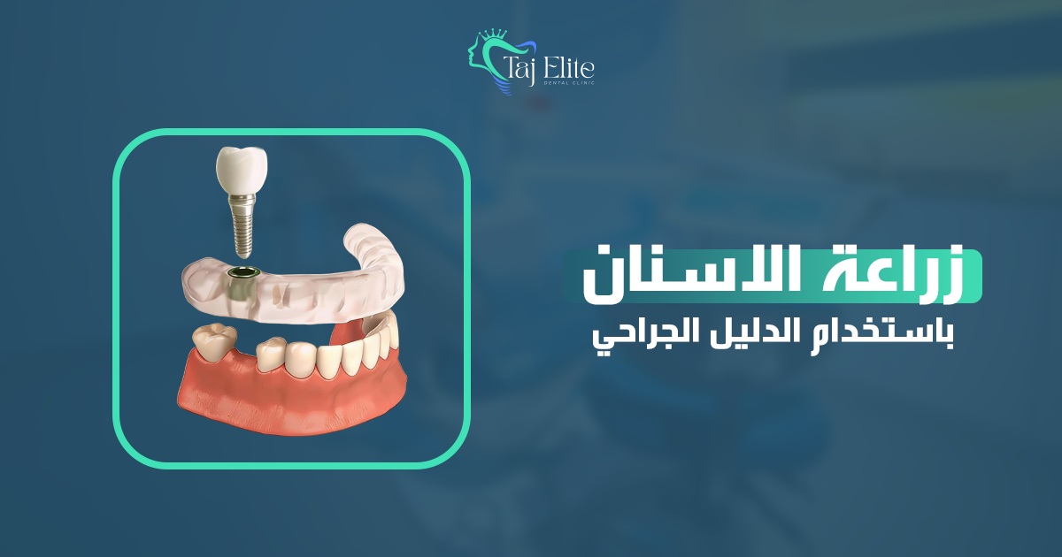 زراعة الأسنان باستخدام الدليل الجراحي (1)
