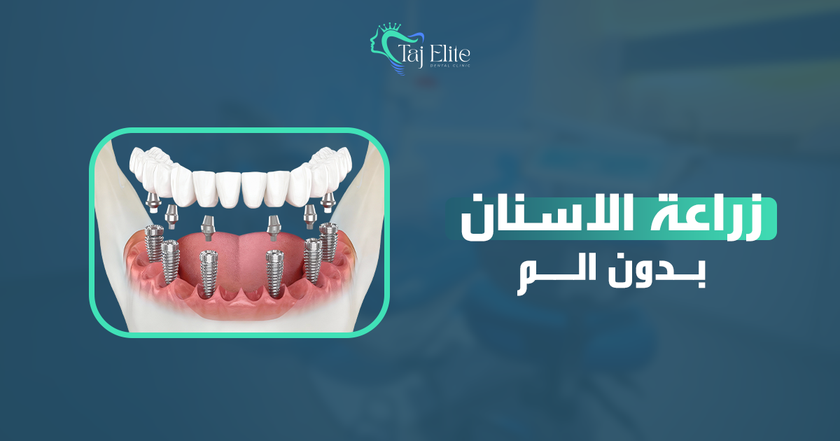 زراعة الاسنان بدون الم