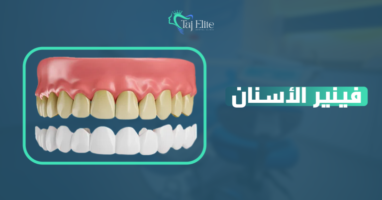 فينير الأسنان